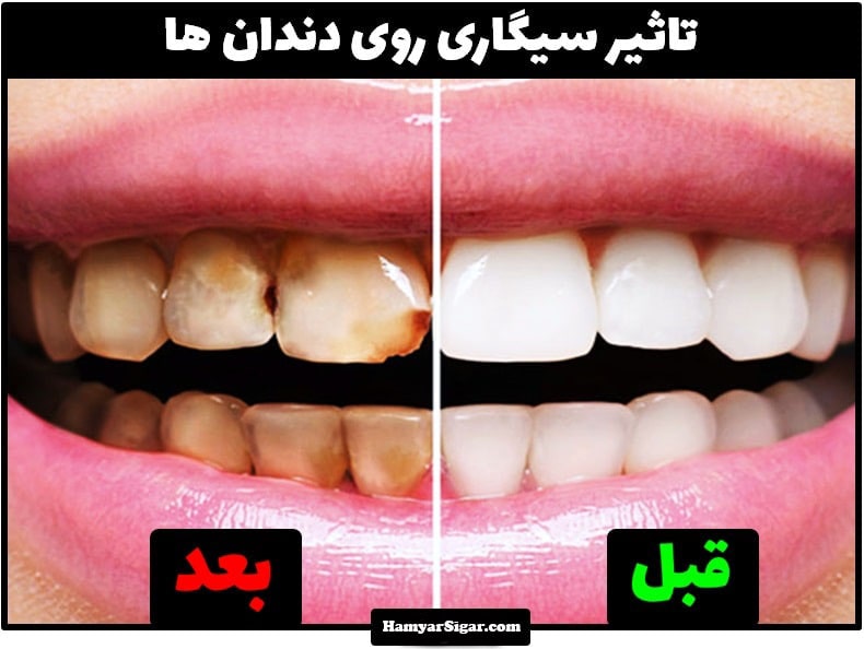 تاثیر سیگار روی دندان ها